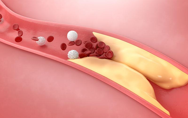 Everything You Need to Know About Symptoms of High Cholesterol