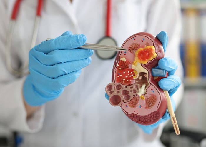 Understanding the Risk Factors for Chronic Kidney Disease